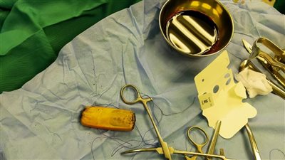 ابتلعه منذ 6 أشهر.. استخراج هاتف من معدة متهم محتجز بأسوان