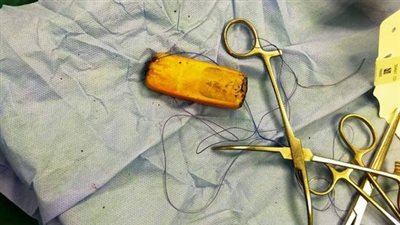 بلعه منذ 6 أشهر.. استخراج هاتف محمول من معدة مواطن بأسوان والطاقم الطبي يكشف التفاصيل