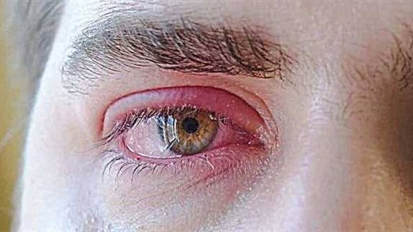 متلازمة سيكا