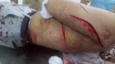 بسبب خلافات زوجية.. الاعتداء على محامي تحت التدريب بالفيوم والأسرة تروي التفاصيل: قطعوه بالكتر وخد 220 غُرزة| صور