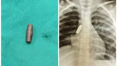 استخراج طلقة نارية من باطن طفلة بعد ابتلاعها بالمنيا