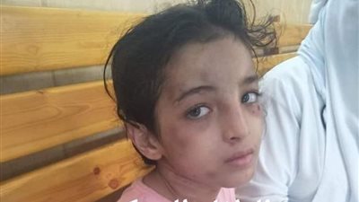 “قومي الطفولة” يتقدم ببلاغ للنائب العام في واقعة تعذيب طفلة بدمياط