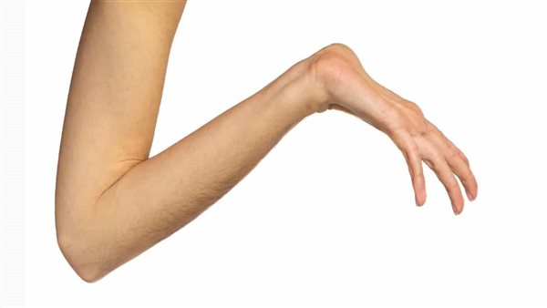 متلازمة مارفان