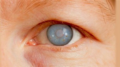 شهر التوعية بالجلوكوما.. لماذا يعد الاكتشاف المبكر أمرًا بالغ الأهمية؟