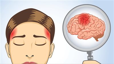  أسباب الصداع المستمر.. وهل يمثل خطرا على المصاب؟