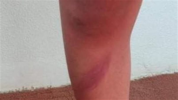 آثار ضرب الطفل يوسف