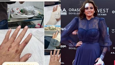 لأول مرة.. بشرى تكشف تفاصيل إصابتها بعد حادث مهرجان الجونة | صورة