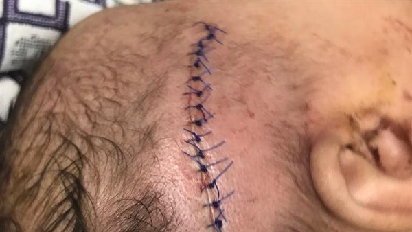 الطفلة المصابة 