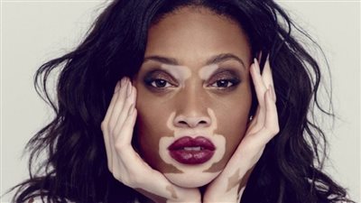 عمليات التمويه.. التصبغ الدقيق يزيد من تجميل البشرة لمرضى البهاق