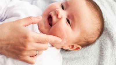 أسباب البهاق عند الأطفال الرضع وهذه أعراضه.. أبرزها التعرض للضغوطات النفسية