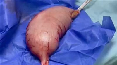 فريق طبي بالإسكندرية ينجح في إجراء جراحة لطفل بالقولون يعاني من صعوبة بالإخراج