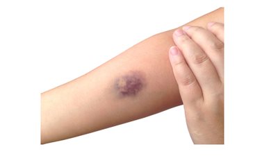 ألوان الكدمات على ماذا تدل؟