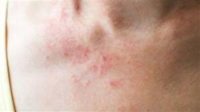 تعرف على أسباب وطرق علاج مرض الساركويد 