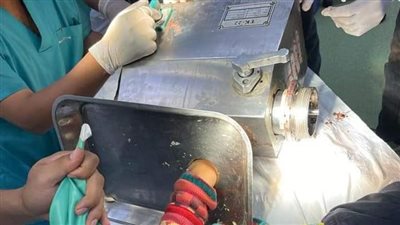 جراحة استمرت 6 ساعات.. إنقاذ يد طفلة ابتلعتها مفرمة اللحوم بسوهاج | صور