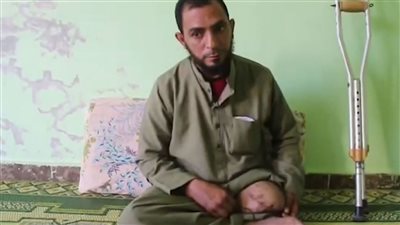 إهمال طبيب.. شاب يفقد قدمه بعد 24 عملية جراحية: الدكتور كسر بُنطة شنيور في رجلي وسابها