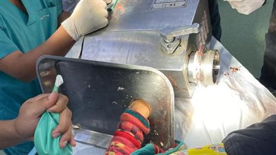أطباء بمستشفى سوهاج الجامعي يستعيدون يد طفلة علقت بداخل مفرمة لحم