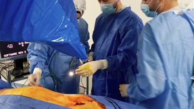 لأول مرة.. استخراج حصوة مرتجعة بحوض الكلى اليسرى بمنظار الكلى بمستشفى السنبلاوين