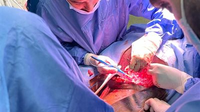 فريق طبي بسوهاج الجامعي ينجح في استخراج لوح خشبي من جسد شاب | صور