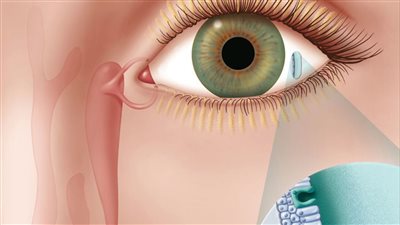 أهمها العدسات اللاصقة وقلة الرمش.. أسباب جفاف العين وكيفية علاجها منزليا