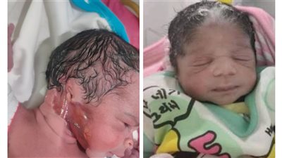 شعر أبيض والبطن غير موجودة وجلد مشوّه.. هل هناك سر لانتشار حالات الولادة النادرة والغريبة بالأقصر؟