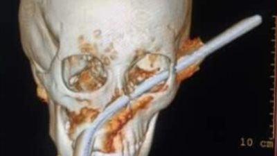 استخراج سيخ حديد من وجه طفل بالمنيا