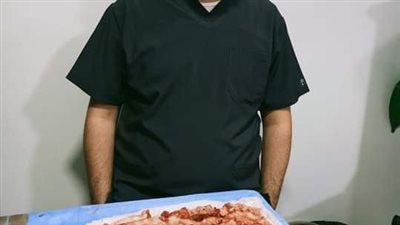  استئصال ورم ليفي يزن 5 كيلو من رحم سيدة بـ بنها  