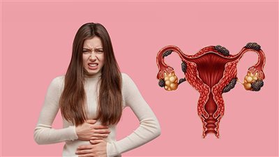  أعراض انفجار كيس الشوكولاتة.. هل يمنع الحمل الطبيعي؟