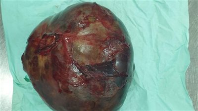 استئصال ورم يزن 200 جم من أمعاء مريض بمستشفى المنشاوي بطنطا