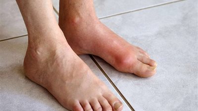 دواء للنقرس يقلل من خطر الإصابة بنوبات قلبية |دراسة 