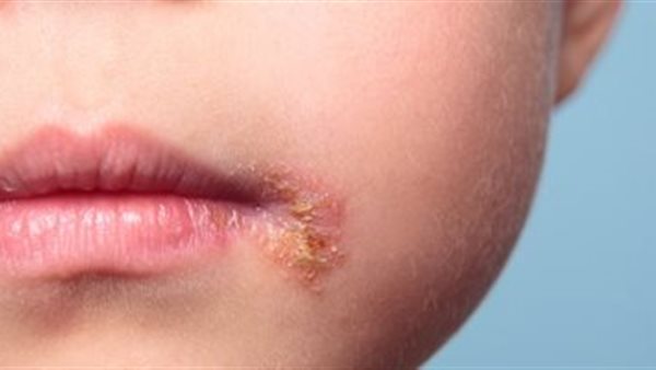  فيروس الهربس الفموي