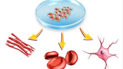 العلاج بالخلايا الجذعية للسكري و3 أمراض عصبية أخرى
