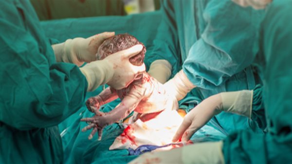 الولادة القيصرية