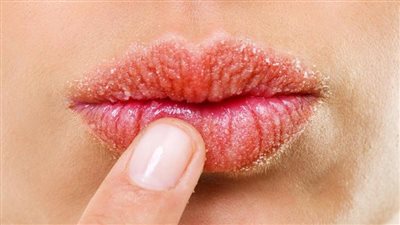 علاج تشقق الشفاه في المنزل.. وصفات تقشير وترطيب ونصائح أخرى لا تفوتك