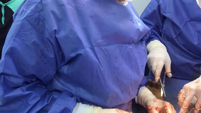 لأول مرة.. إجراء عملية زرع وريد صناعي لمريض فشل كلوي بمستشفى السنبلاوين العام