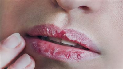 7 طرق منزلية لعلاج جفاف الشفاه في فصل الصيف