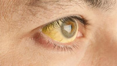 اصفرار الجلد وبياض العين.. تعرف على مرض اليرقان