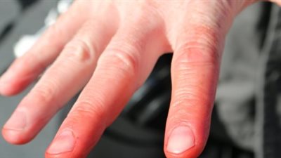 يعرّض الأطراف والأصابع للتورم والاحمرار.. تعرف على عضة الصقيع وكيفية علاجها