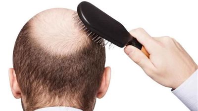 استشاري أمراض جدلية: المتعافون من كورونا يتعرضون لتساقط كثيف للشعر