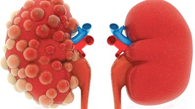 الخبراء يحذرون.. إذا لاحظت هذا على بشرتك قم بفحص الكلى