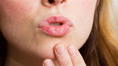  بالعسل والفازلين..علاج تشقق الشفاه بسرعة ونصائح تجميلية لا تفوتك