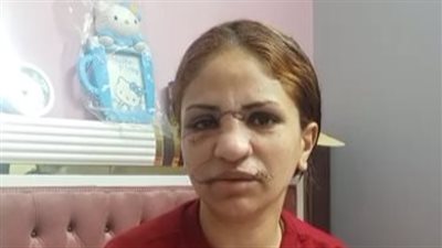 165 غرزة في وجهها.. عامل يعتدي على زوجته ويشوه وجهها بالوراق