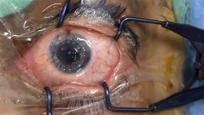 للمرة العاشرة.. نجاح إجراء عملية جراحية لزراعة قرنية كاملة بمستشفى رمد المنيا