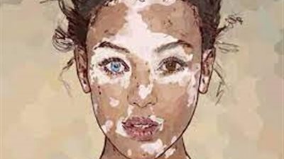 علامات البهاق وكيفية التأكد منه.. تعرف على التفاصيل