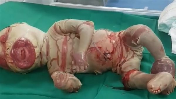 ولادة طفل شمعي دون