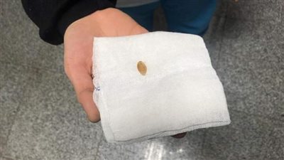 بنها الجامعي يستخرج قشرة لب محشورة بين الأحبال الصوتية لطفل عمره عام