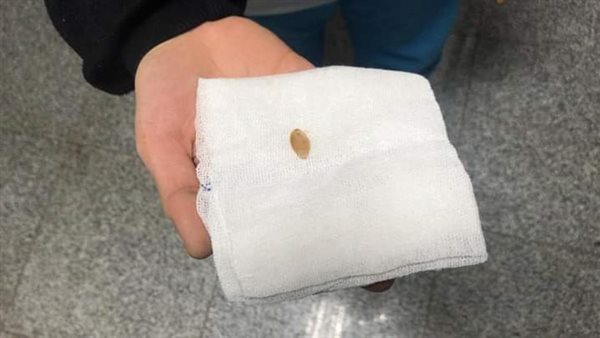 استخراج قشرة لب منحشرة