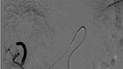 فريق طبى ببنها الجامعى ينجح فى عملية  حقن ورم كبدي كبير الحجم لمريضة  تبلغ من العمر 51 عامًا