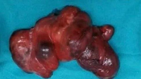 الورم المستئصل من