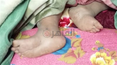 داء الفيل يُهدد حياة مُسنة تعيش وحدها بالشرقية.. والمريضة تستغيث بالمسئولين | صور