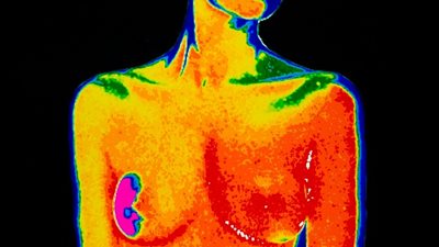 تغيير جذري.. نظام جديد لفحص سرطان الثدي يكشف أورام أخرى